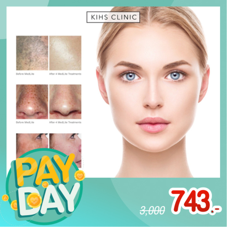 เลเซอร์ MedLite C6 ลดรอยสิว ฝ้า กระ จุดด่างดำ ทั่วใบหน้า 1 ครั้ง ที่ KIHS Clinic