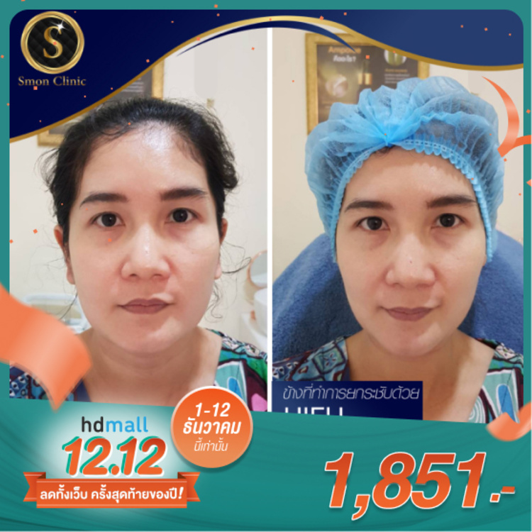 ทำ HIFU Micro Lift ไม่จำกัดช็อต ขึ้นอยู่กับแพทย์ประเมิน บริเวณใบหน้า 1 ครั้ง ที่ Smon clinic