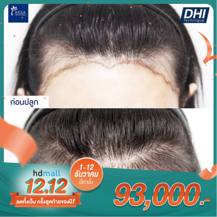 ปลูกผม ด้วยเทคนิค DHI ไม่เกิน 1,000 กราฟต์ พร้อมแพ็กเกจบำรุงและดูแลผม 8 รายการ ที่ Kesa Hair Solution & Aesthetic