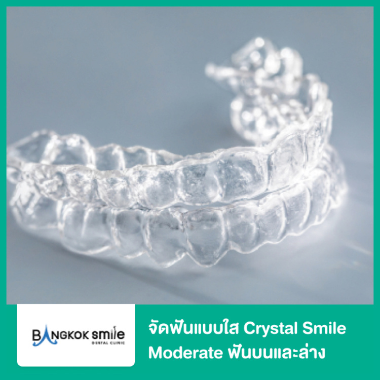 จัดฟันแบบใส Crystal Smile Moderate ฟันบนและล่าง ที่ Bangkok Smile Dental
