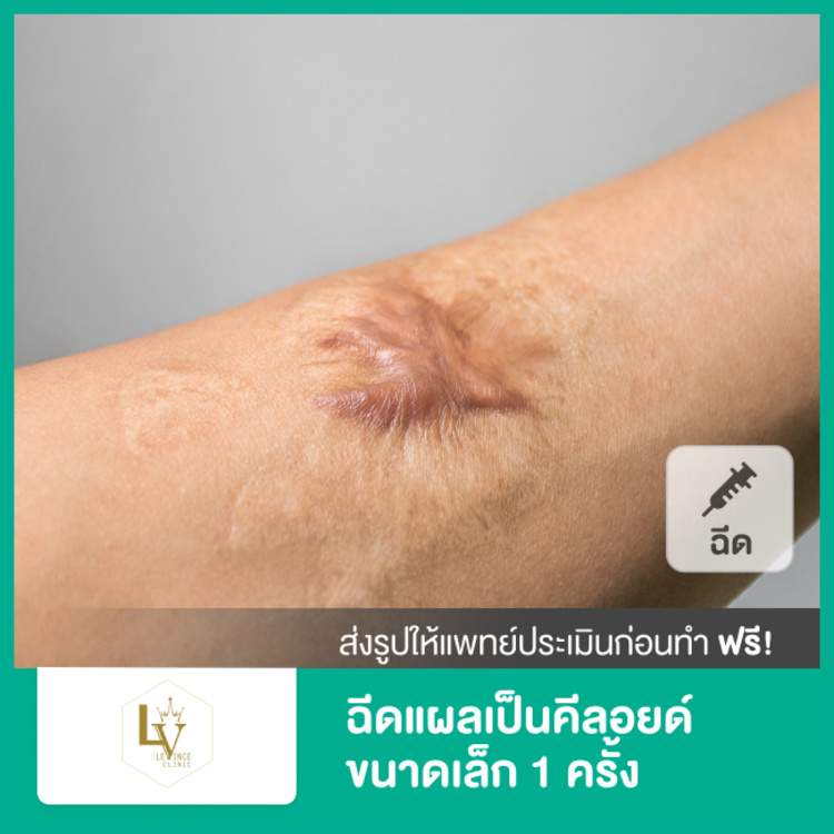 ฉีดแผลเป็นคีลอยด์ขนาดเล็ก 1 ครั้ง ที่ Levince clinic