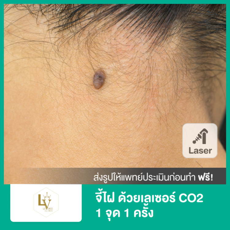 จี้ไฝ ด้วยเลเซอร์ CO2 1 จุด 1 ครั้ง ที่ Levince clinic