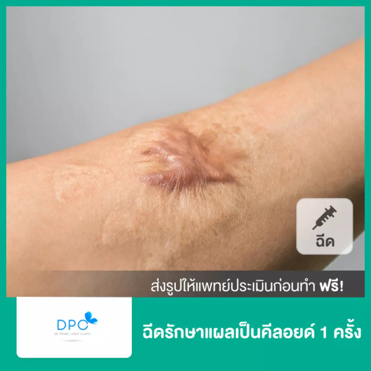 ฉีดรักษาแผลเป็นคีลอยด์ 1 ครั้ง ที่ DPC Beauty Clinic
