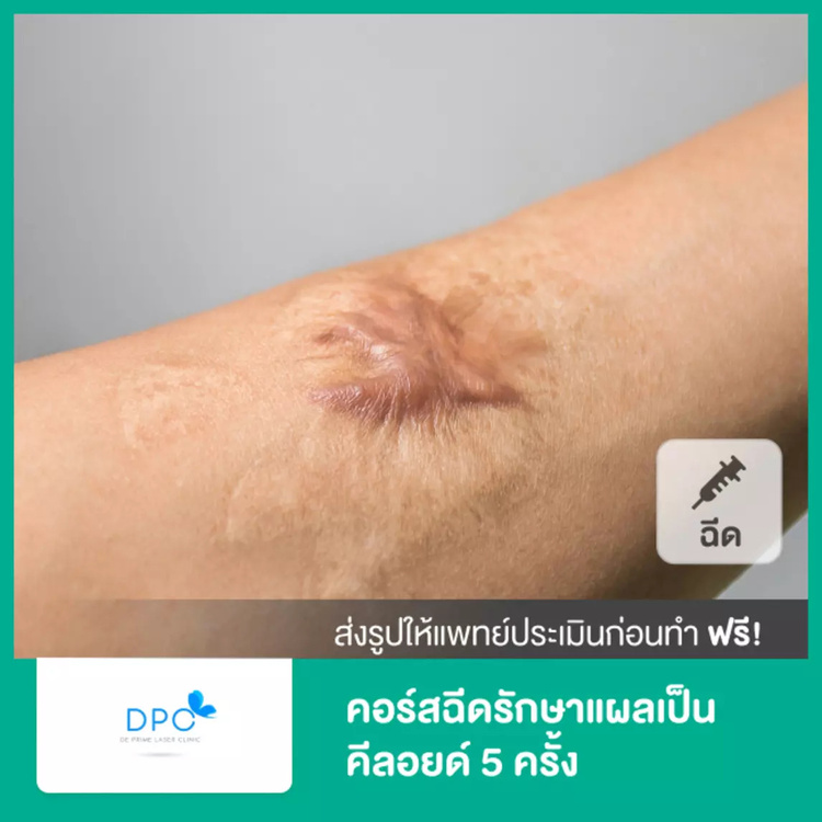 คอร์สฉีดรักษาแผลเป็นคีลอยด์ 5 ครั้ง ที่ DPC Beauty Clinic