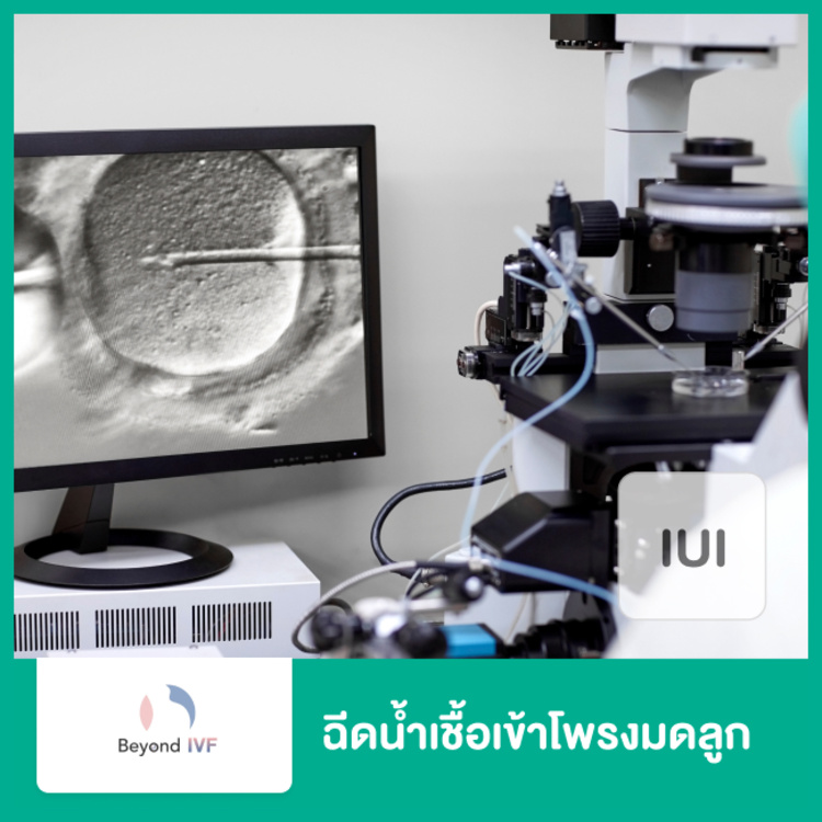 ฉีดน้ำเชื้อเข้าสู่โพรงมดลูก (IUI) ที่ Beyond IVF by Meko