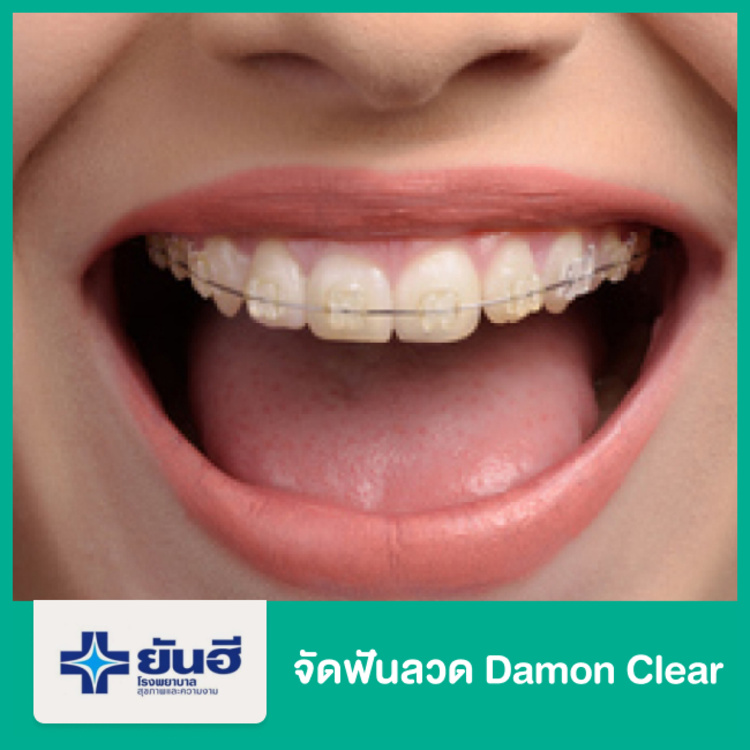 จัดฟันลวด Damon Clear ที่ โรงพยาบาลยันฮี