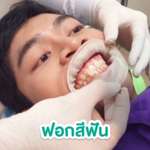 รีวิว ฟอกสีฟัน ที่ Let Smile Dental Clinic