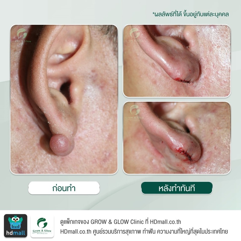 รีวิวตัดคีลอยด์ ที่ GROW & GLOW Clinic