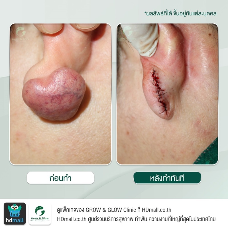 รีวิวตัดคีลอยด์ ที่ GROW & GLOW Clinic