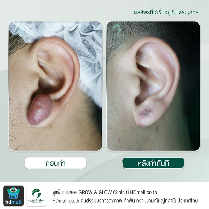 รีวิวตัดคีลอยด์ ที่ GROW & GLOW Clinic