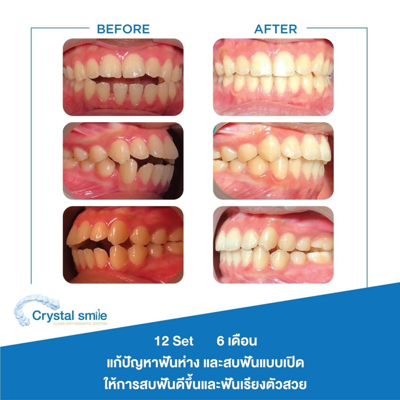 รีวิว จัดฟันใส Crystal Smile ที่ Bangkok Smile Dental
