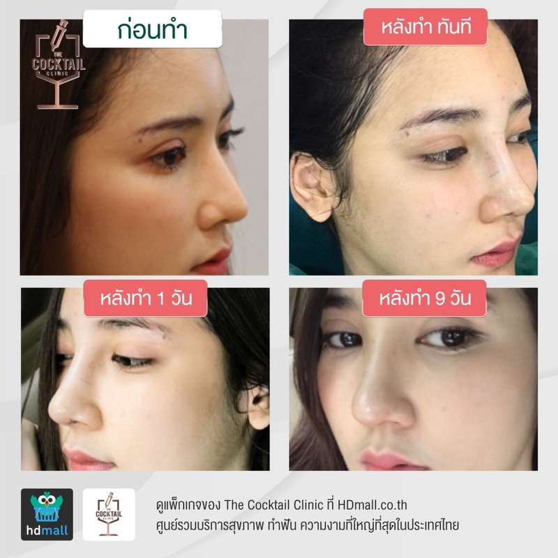 รีวิวศัลยกรรมจมูก