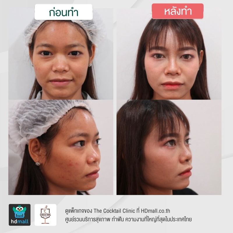 รีวิวศัลยกรรมจมูก