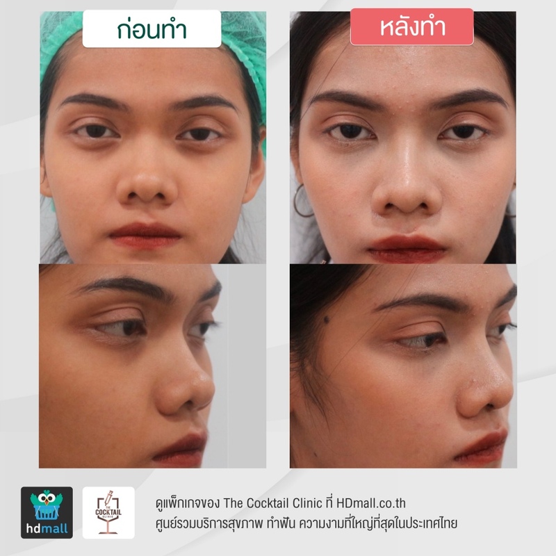 รีวิวศัลยกรรมจมูก