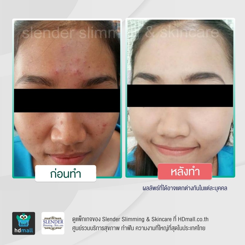รีวิว รักษาสิว